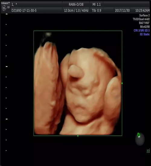 畸形胎儿   (部分案例)      (胎儿唇裂)        (胎儿全前脑并单鼻孔
